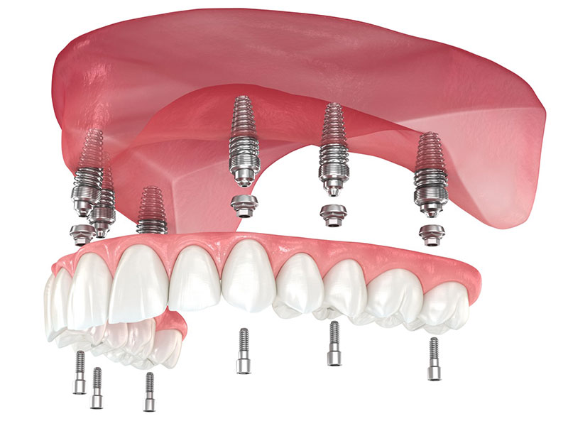 All-on-six-Koncept-Kosovic-Dental