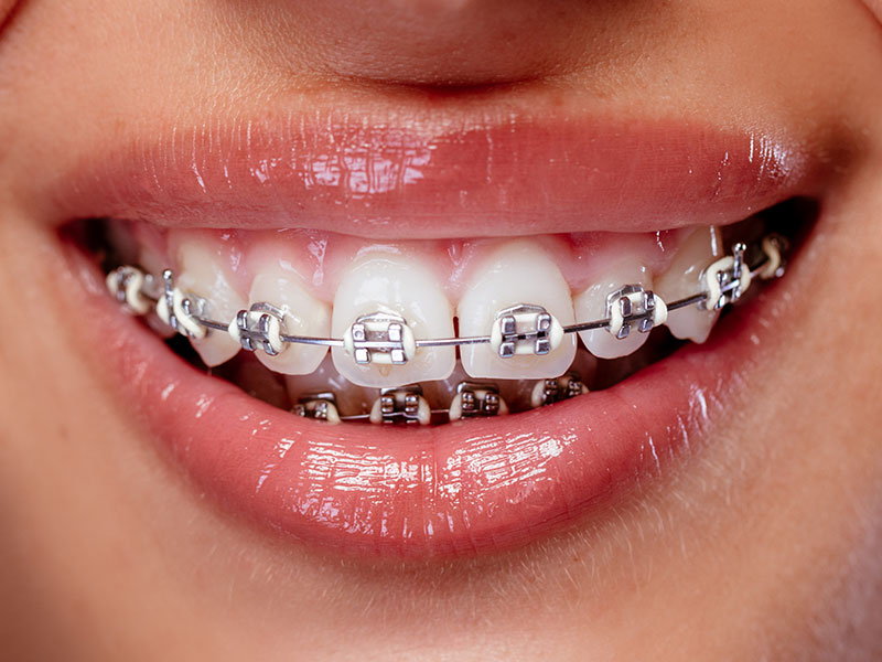 Postizanje-optimalnog-polozaja-zuba-ortodoncija-Novi-Sad